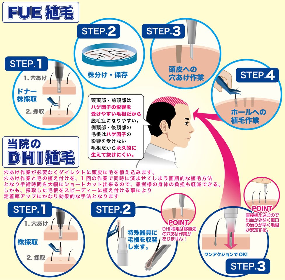 植毛の手法 | トルコ植毛案内所