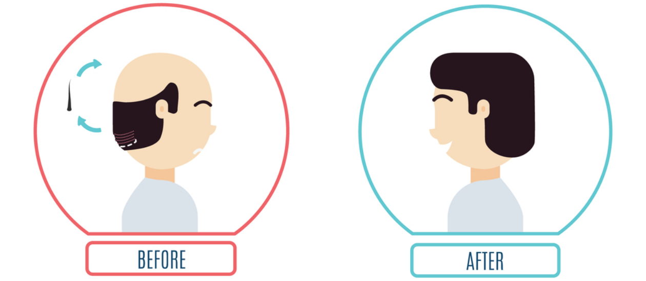 植毛の手法 | トルコ植毛案内所